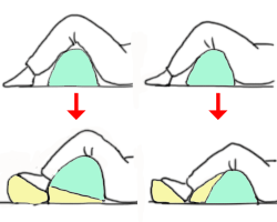 ナーセント・アップニー使用例。アップニーと下肢の間に隙間ができる時。隙間があるとポジショニングの効果は得られなくなります。また、膝裏に圧迫が集中すると神経障害・血流障害を生じるので危険な状態です。隙間ができないように、アップニーとは別のクッションを併用してイラストのように対処してください。要点は、膝裏を直接支持しないこと、大腿部の重量を受けること、下腿部の重量を受けること、尖足(=せんそく)予防のクッションを使用すること、です。